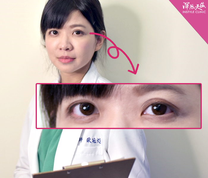 渾然天成整形醫美-雙眼皮-醫師也有整型需求？告別無神、大小眼