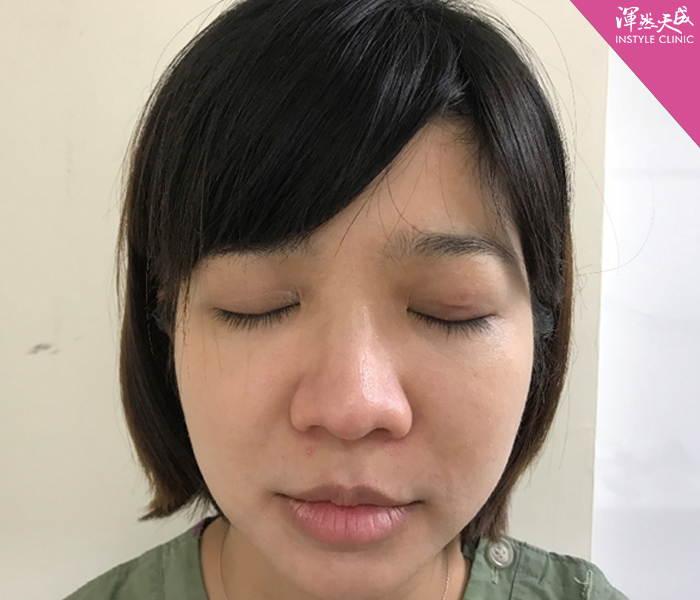 渾然天成整形醫美-雙眼皮-醫師也有整型需求？告別無神、大小眼