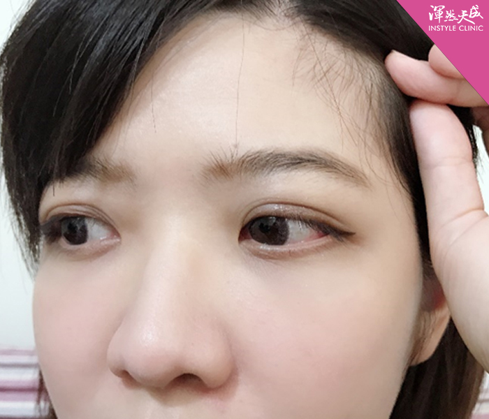 渾然天成整形醫美-雙眼皮-醫師也有整型需求？告別無神、大小眼