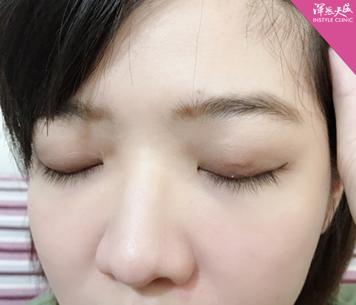 渾然天成整形醫美-雙眼皮-醫師也有整型需求？告別無神、大小眼