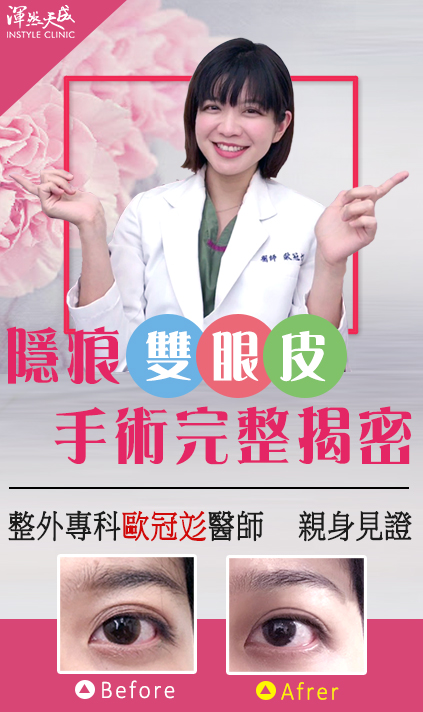 渾然天成整形醫美-雙眼皮-醫師也有整型需求？告別無神、大小眼