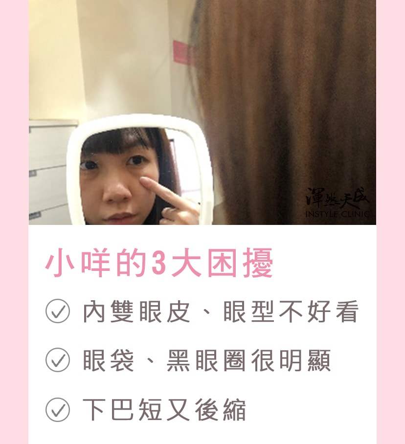 渾然天成整形醫美-小咩的3大困擾:1.內雙眼皮、眼型不好看 2.眼袋、黑眼圈很明顯 3.下巴短又後縮