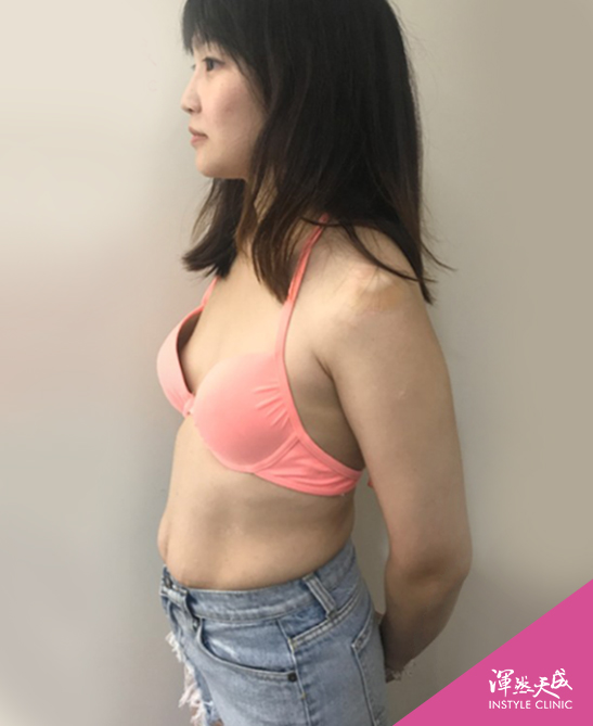 渾然天成整形醫美-產後的身材,實在是太「驚為天人」啦! 渾然天成整形醫美-終於擺脫了產後身材走樣的陰霾,揭開我的美麗人生~