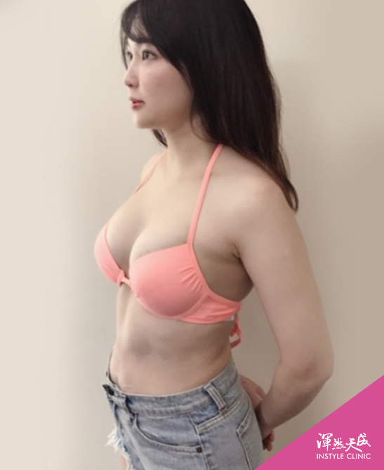 渾然天成整形醫美-終於擺脫了產後身材走樣的陰霾,揭開我的美麗人生~ 渾然天成整形醫美-終於擺脫了產後身材走樣的陰霾,揭開我的美麗人生~