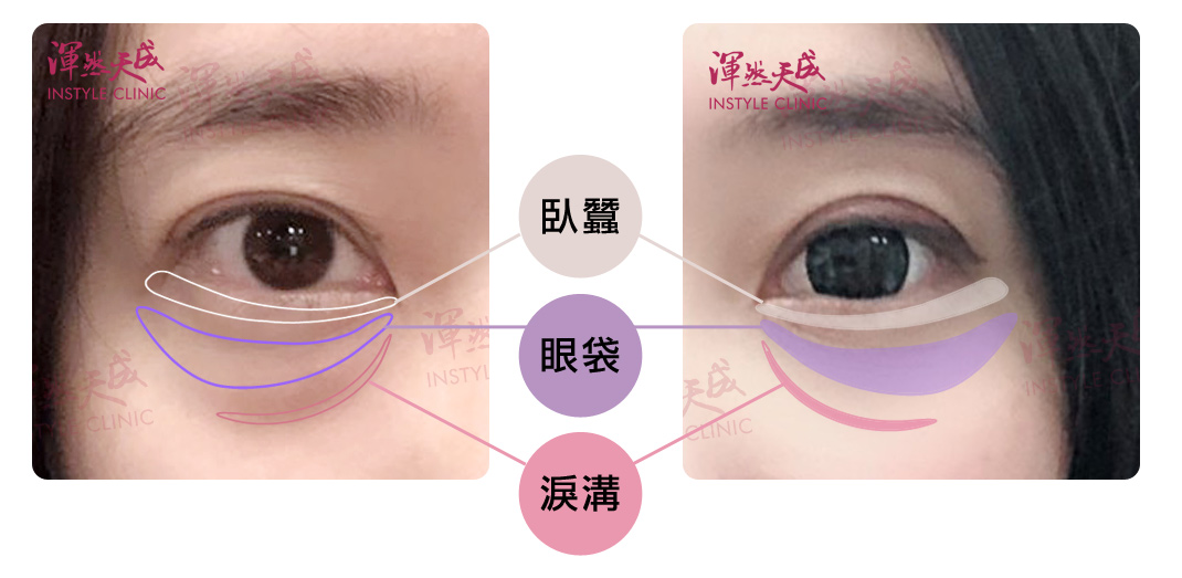 臥蠶眼袋淚溝怎麼分辨? 臥蠶眼袋淚溝怎麼分辨?