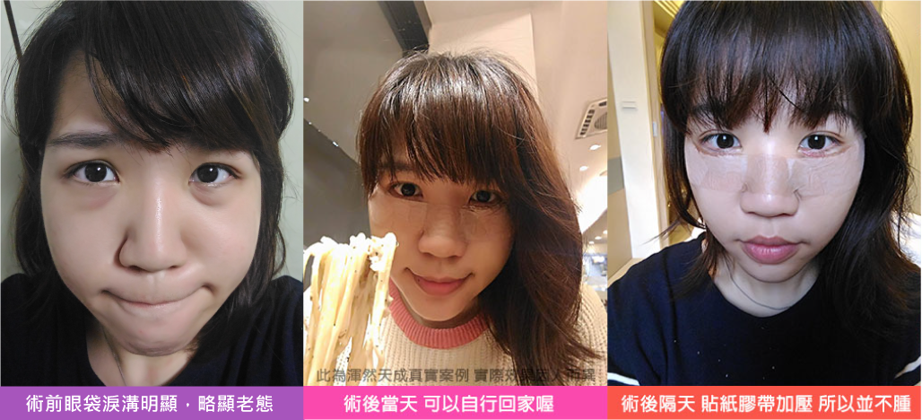 渾然天成,眼袋,淚溝,無痛,無疤痕,舒眠,術後,恢復期
