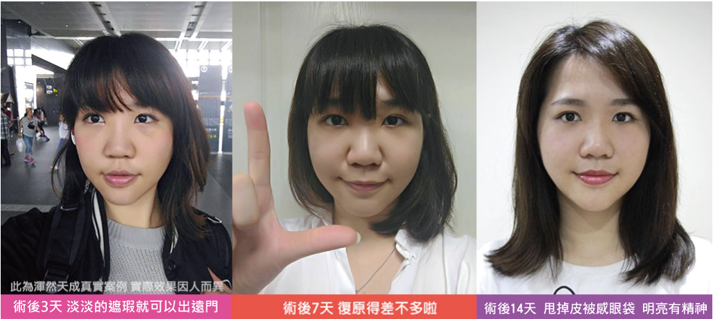 渾然天成,眼袋,淚溝,無痛,無疤痕,舒眠,術後,恢復期