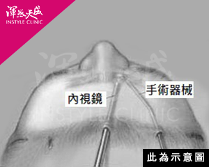 渾然天成,拉提,台北,醫美,整形,腫,推薦,消腫,內視鏡,提眉,諮詢,自然,疤痕,魚尾紋,手術,麻醉,無痛,術前,術後,抬頭紋,醫師,專業,保養,費用,拉皮,無疤,缺點,恢復期,眉間紋,額頭,老化,價格,價錢,費用,失敗,微整,微整型,ptt,種類,位置