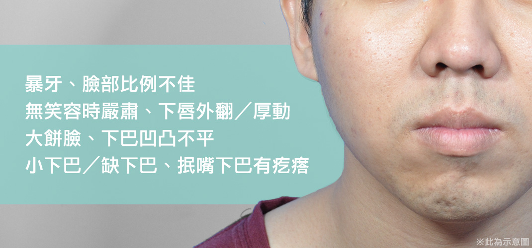渾然天成,整形,醫美,下巴,墊下巴,費用,價格,價錢,價位,台北,術前,術後,手術,材質,消腫,恢復期,失敗,後遺症,ptt,推薦,人工骨,方式,傷口,痕跡,外開,內開,價位,脂肪,量身訂做,立體,疤痕,影響,麻醉,淺舒眠麻醉＋鎮定止痛＋局部麻醉,玻尿酸,微晶瓷,晶亮瓷,模擬,模型