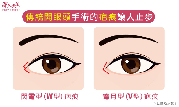 傳統開眼頭手術W型、V型疤痕|渾然天成整形醫美 傳統開眼頭手術W型、V型疤痕|渾然天成整形醫美。