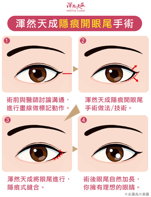 隱痕開眼尾手術方式|渾然天成整形醫美 隱痕開眼尾手術方式|渾然天成整形醫美。