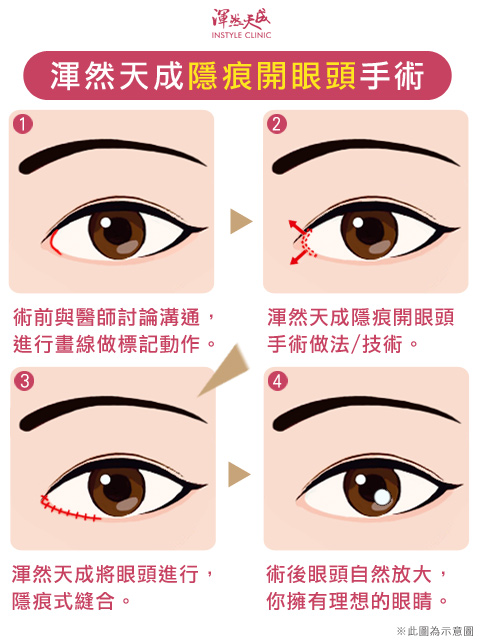 渾然天成隱痕開眼頭手術方式|渾然天成整形醫美 渾然天成隱痕開眼頭手術方式|渾然天成整形醫美。