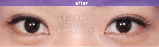 渾然天成,雙眼皮,訂書針雙眼皮,割雙眼皮,縫雙眼皮,恢復,無疤,無痛,術後,恢復期,手術,整形,費用,掉針,無疤,缺點,妝,量身訂做
