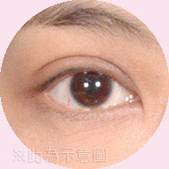 雙眼皮-寬摺(半開放式)|渾然天成整形醫美 雙眼皮-寬摺(半開放式)|渾然天成整形醫美