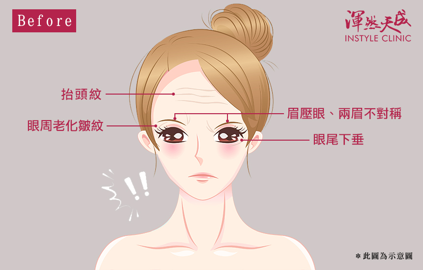 渾然天成整形醫美|眉壓眼、兩眉不對稱、眼尾下垂、眼周老化皺紋、抬頭紋。 渾然天成整形醫美|眉壓眼、兩眉不對稱、眼尾下垂、眼周老化皺紋、抬頭紋。