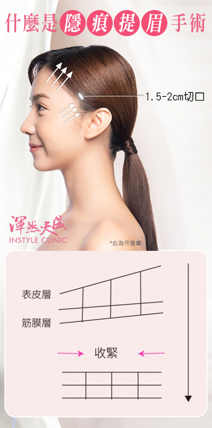 渾然天成整形醫美|什麼是隱痕提眉手術 渾然天成整形醫美|什麼是隱痕提眉手術