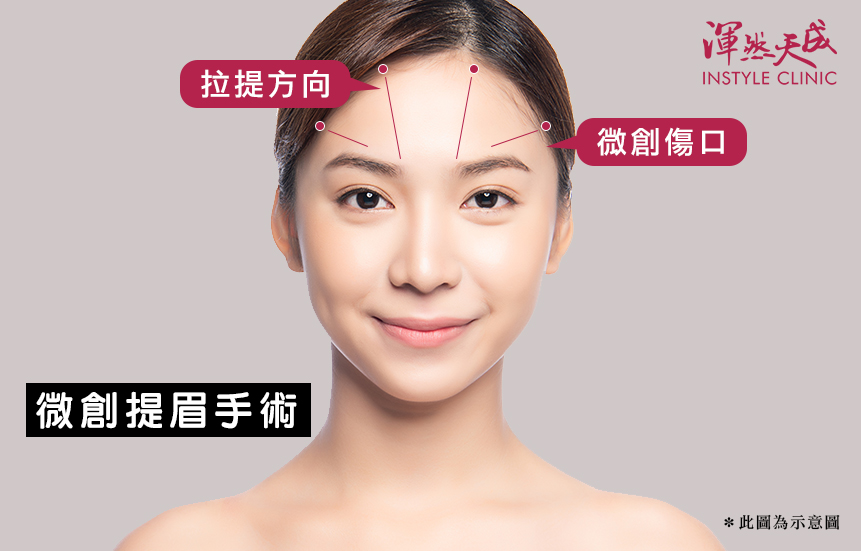 渾然天成整形醫美|隱痕提眉切口與拉提方向。 渾然天成整形醫美|隱痕提眉切口與拉提方向。