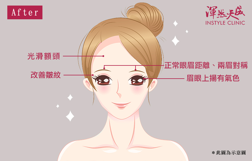 渾然天成整形醫美|恢復正常眼眉距離、兩眉對稱、眉眼上揚有氣色、改善皺紋。 渾然天成整形醫美|恢復正常眼眉距離、兩眉對稱、眉眼上揚有氣色、改善皺紋。