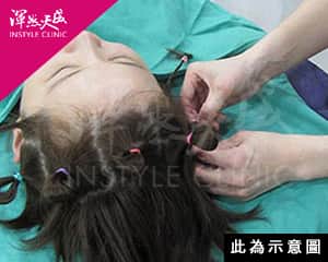 術前幫您保護好頭髮|渾然天成整形醫美 術前幫您保護好頭髮|渾然天成整形醫美