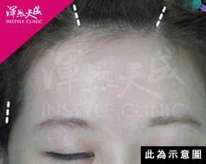 微創內視鏡前額拉皮|渾然天成整形醫美 微創內視鏡前額拉皮|渾然天成整形醫美