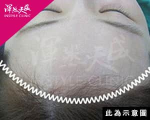 髮際線拉皮|渾然天成整形醫美 髮際線拉皮|渾然天成整形醫美