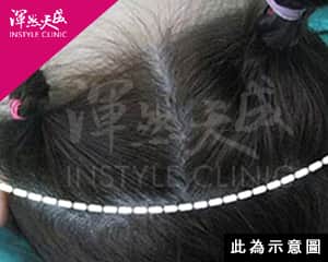 傳統髮際線後拉皮|渾然天成整形醫美 傳統髮際線後拉皮|渾然天成整形醫美