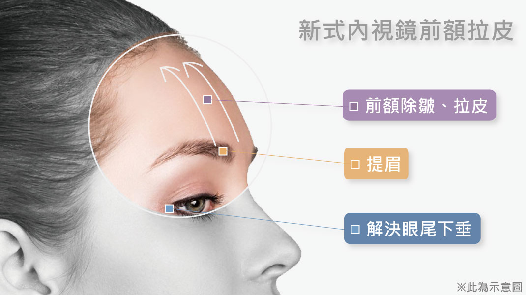 微創內視鏡前額拉皮手術。|渾然天成整形醫美 微創內視鏡前額拉皮手術。|渾然天成整形醫美。
