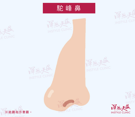 駝峰鼻:鼻背高、鼻樑凸起。|渾然天成整形醫美 駝峰鼻:鼻背高、鼻樑凸起。|渾然天成整形醫美