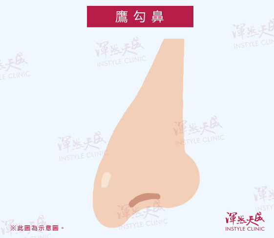鷹勾鼻:鼻頭長、鼻尖下垂。|渾然天成整形醫美 鷹勾鼻:鼻頭長、鼻尖下垂。|渾然天成整形醫美