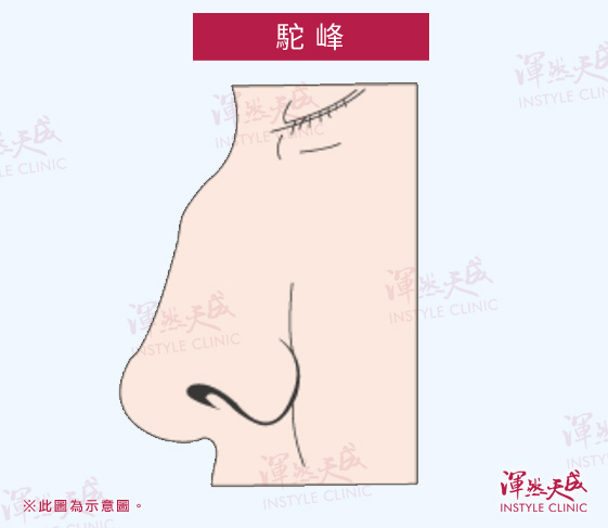 駝峰|渾然天成整形醫美 駝峰|渾然天成整形醫美
