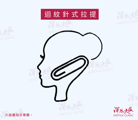 迴紋針式拉提|渾然天成整形醫美 迴紋針式拉提|渾然天成整形醫美