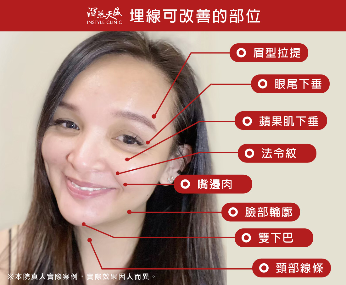 渾然天成整形醫美|埋線可改善的部位 渾然天成整形醫美|埋線可改善的部位