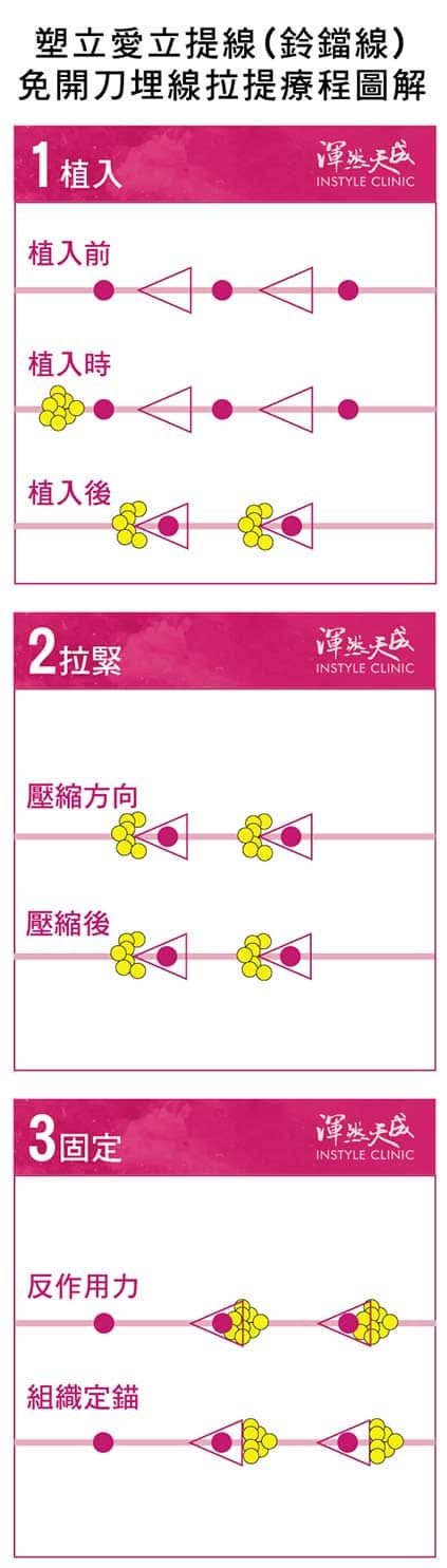塑立愛立提線作用方式圖文解析 塑立愛立提線(鈴鐺線)作用方式圖文解析