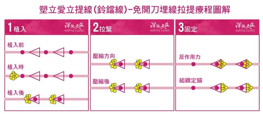 塑立愛立提線(鈴鐺線)作用方式圖文解析