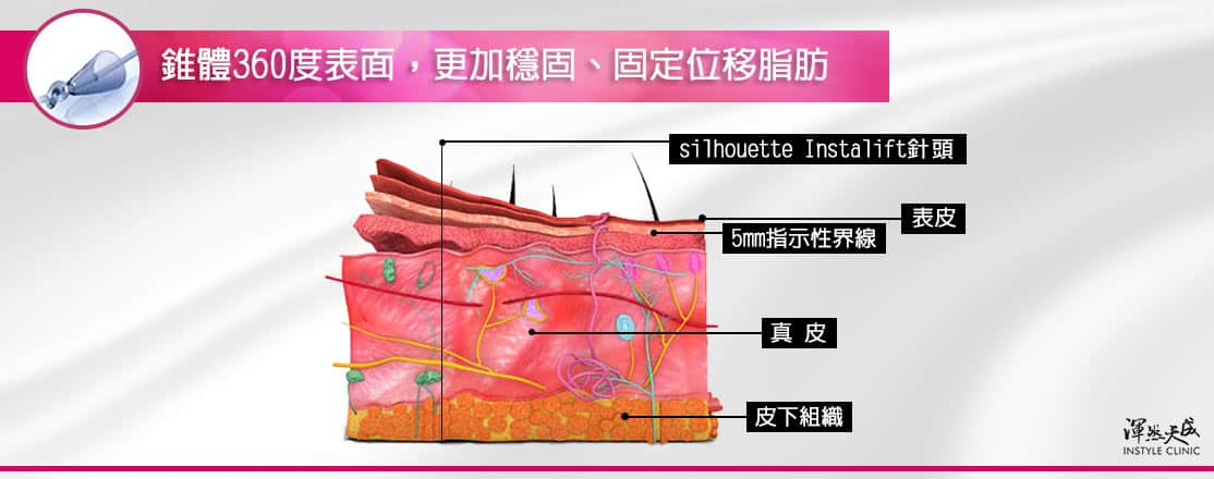 鈴鐺線錐體360度表面，更加穩固、固定位移脂肪