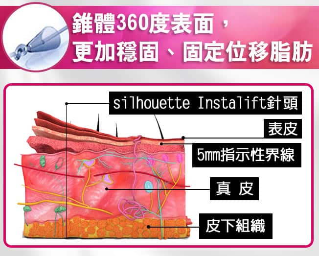 鈴鐺線錐體360度表面,更加穩固 鈴鐺線錐體360度表面,更加穩固、固定位移脂肪