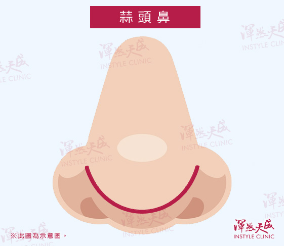 蒜頭鼻|渾然天成整形醫美 蒜頭鼻|渾然天成整形醫美