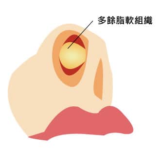多餘脂軟組織 多餘脂軟組織