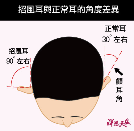 招風耳VS正常耳