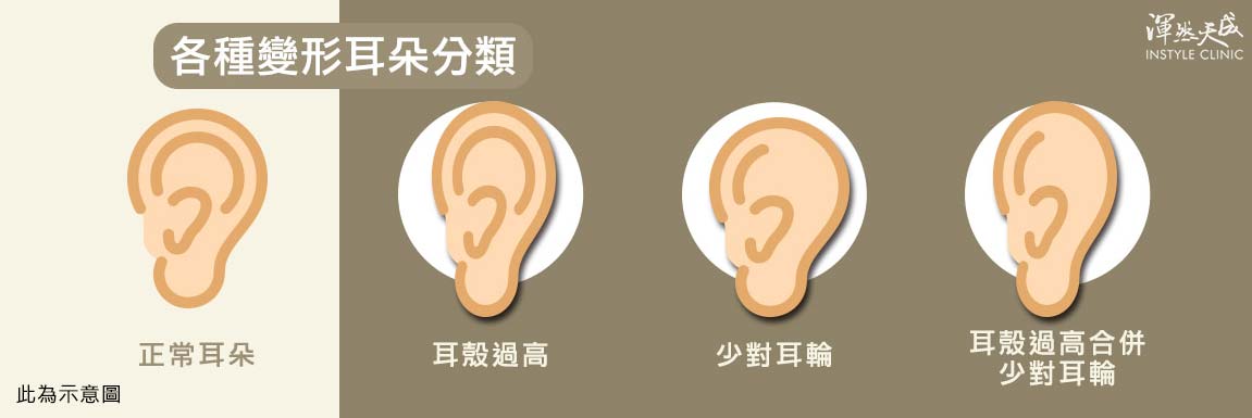 招風耳問題,耳朵畸形,耳多變形,耳朵畸形矯正