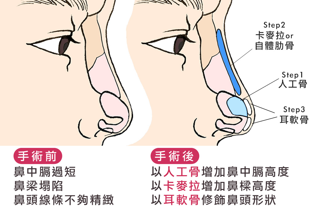 隆鼻手術步驟|渾然天成整形醫美 隆鼻手術步驟|渾然天成整形醫美