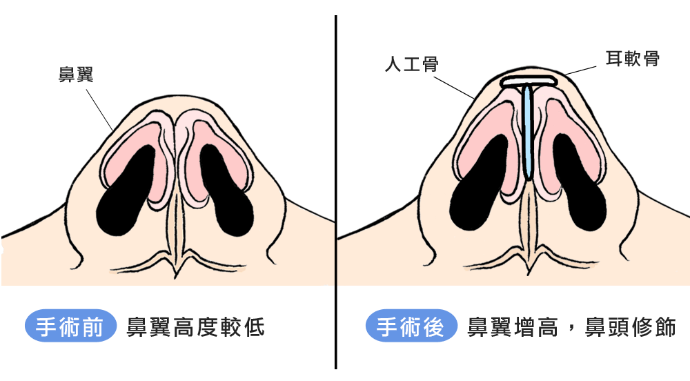 隆鼻術前/術後比較圖|渾然天成整形醫美 隆鼻術前/術後比較圖|渾然天成整形醫美