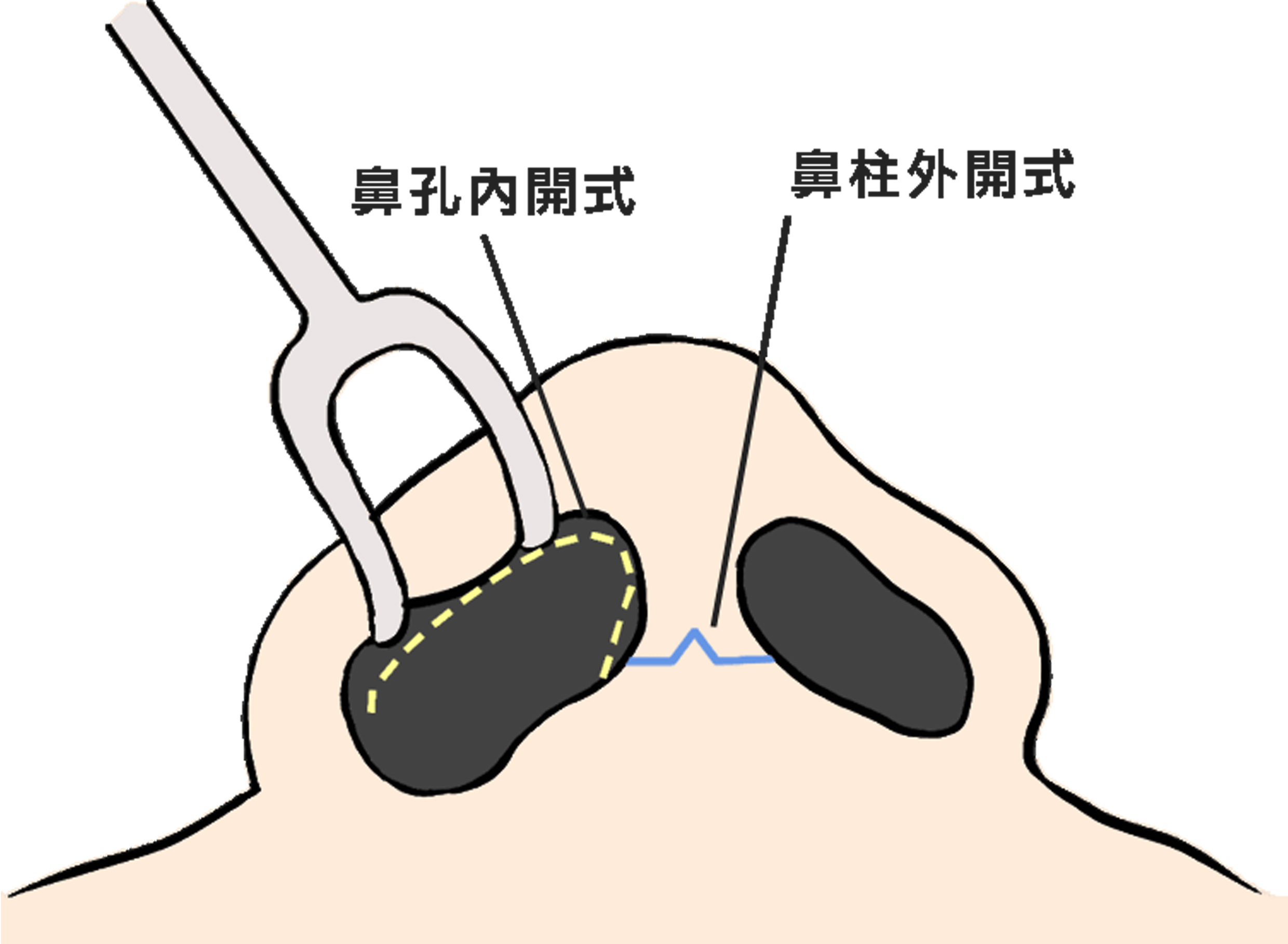 隆鼻內開與外開手術切口位置|渾然天成整形醫美 隆鼻內開與外開手術切口位置|渾然天成整形醫美