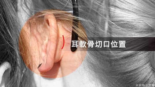 渾然天成,整形,醫美,鼻,隆鼻,費用,價格,價錢,價位,台北,山根,軟骨,術前,術後,手術,材質,消腫,恢復期,失敗,後遺症,ptt,推薦,人工骨,方式,傷口,痕跡,蒜頭鼻,朝天鼻,價位,脂肪,鼻樑,鼻頭,疤痕,影響,麻醉,淺舒眠麻醉＋鎮定止痛＋局部麻醉,皮下,骨膜下,L型,I型,內開,外開,鼻模,鼻翼
