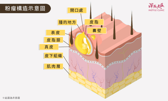 皮脂腺囊腫-粉瘤構造示意圖|渾然天成整形醫美 皮脂腺囊腫-粉瘤構造示意圖|渾然天成整形醫美。