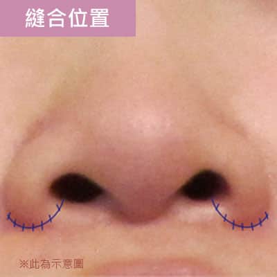 縫合位置 縫合位置