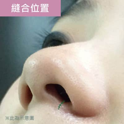 縫合位置 縫合位置