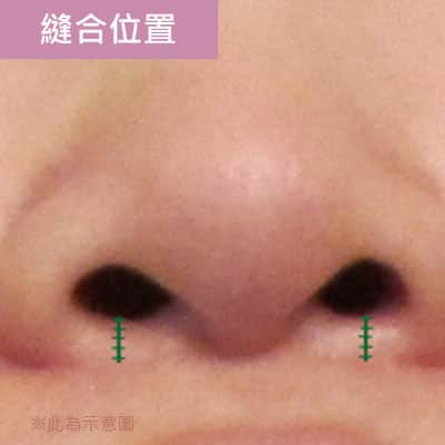 縫合位置 縫合位置