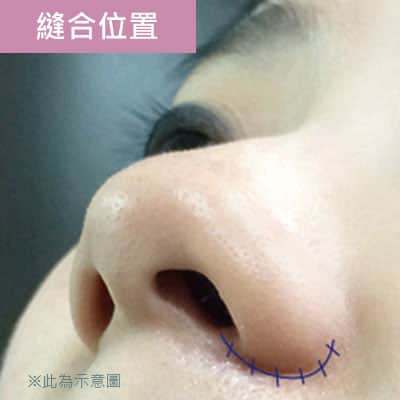 縫合位置 縫合位置