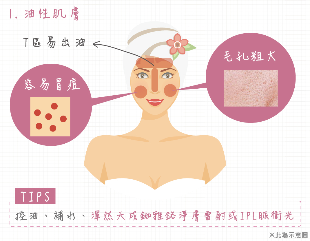 渾然天成,眼袋,抽眼袋,割眼袋,沒睡飽,憔悴,隱形眼鏡,黑眼圈,術後,恢復期